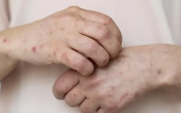 Casos de sarampo aumentam em São Paulo; 36 infecções em 2023