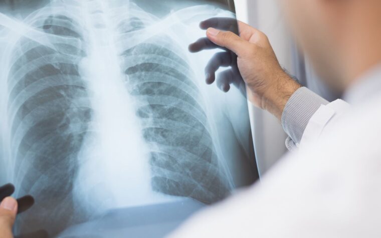 Medicamento inovador para câncer de pulmão avançado ganha aval da Anvisa